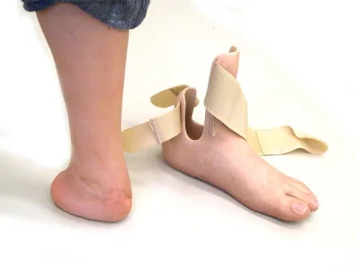 Orthotec Orthopädietechnik Prothesen Massanfertiung Vorfussprothese knöchelübergreifendOrthotec Orthopädietechnik Prothesen Massanfertiung Vorfussprothese knöchelübergreifend