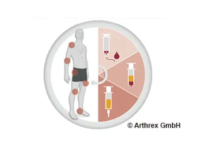 Eigenbluttherapie oder ACP-Therapie in der Sportmedizin Nottwil. Image Copyright by Arthrex GmbH.