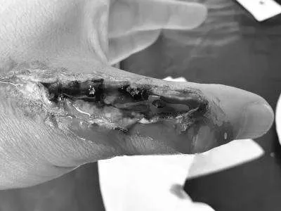 Offene Wunde am Daumen