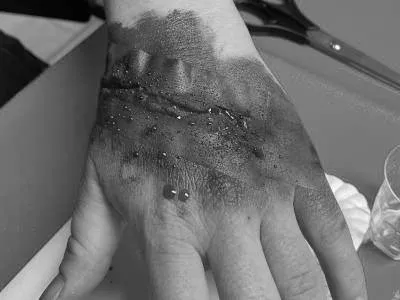 Schnelle Moulage mit Klebstreifen