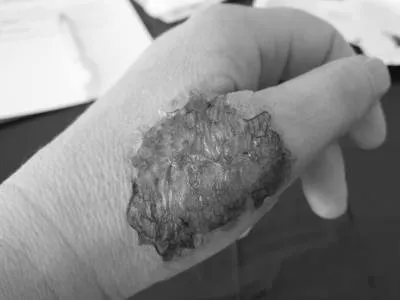 Schürfung auf Hand