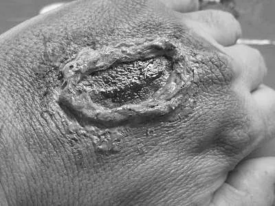 Strom Austrittswunde