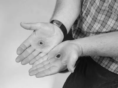 Strom Ein- und Austrittswunde