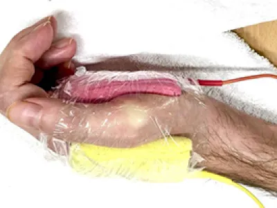 Contracture prophylaxis