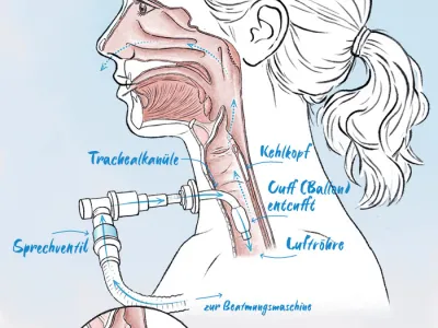 Illustration der Funktion eines Sprechventils