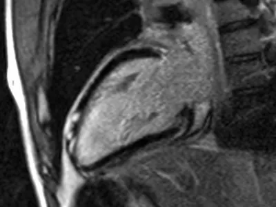 Befundung Kardiale MRT