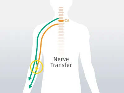 Nerventransfer