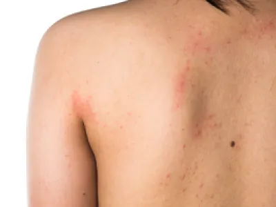 Allergie, Ausschlag