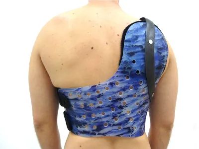 Orthotec Orthopädietechnik Orthesen Schulterorthesen Massanfertigung Scapula Alata Orthese