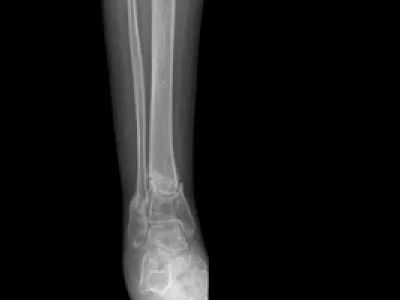 osteoporose
