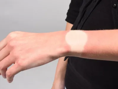 Sonnenstich / Hitzeschlag