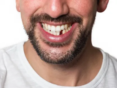 Ausgeschlagener Zahn