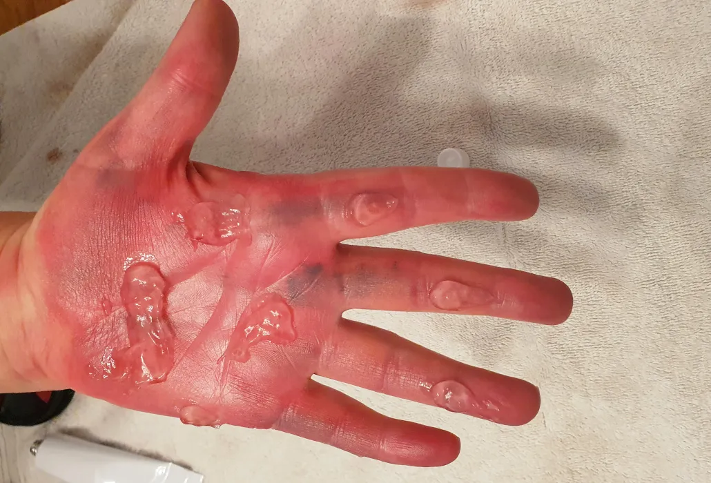 Blasengel trocknen lassen