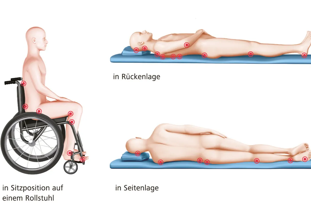 Illustration Druckstellen bei Querschnittgelähmten