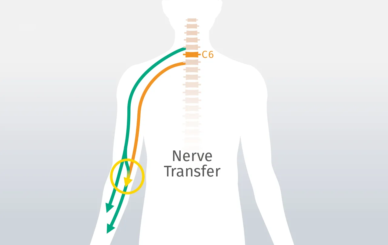 Nerventransfer