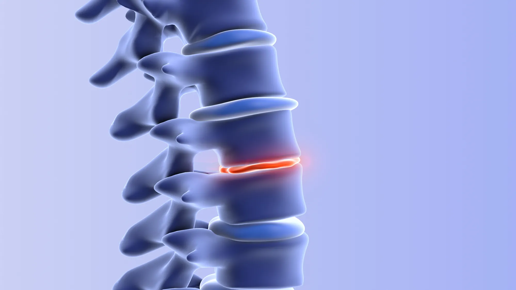 Illustration_Spinalkanalstenose